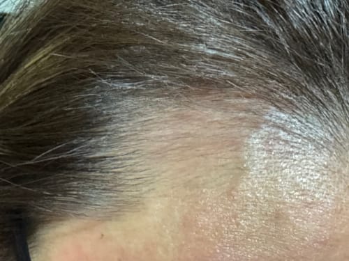 Customer photo review of mesoestetic tricology lotion (5mL x 8)