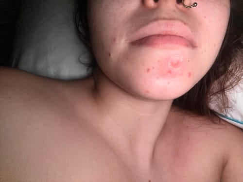 Customer photo review of VT - Cica Care Spot Patch