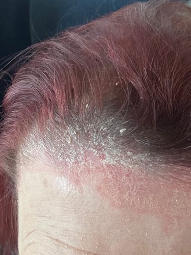 Customer photo review of Scalp & Body Care For Your: Psoriasis, Eczema, Itching, Sores, Scabs & Dandruff - 10 Minute Miracle - Essential Bundle