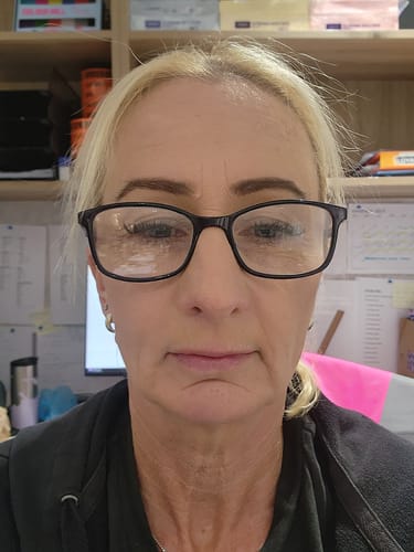 Customer photo review of VT Cosmetics  Reedle Shot Lip Plumper (Beginner)