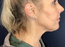 Customer photo review of LumiSkin Brush – Pour un visage défatigué et sculpté en quelques minutes