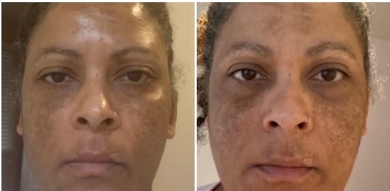 Customer photo review of LightenUp PLUS Active Lightening Cream - 100ml / 3.4 Oz