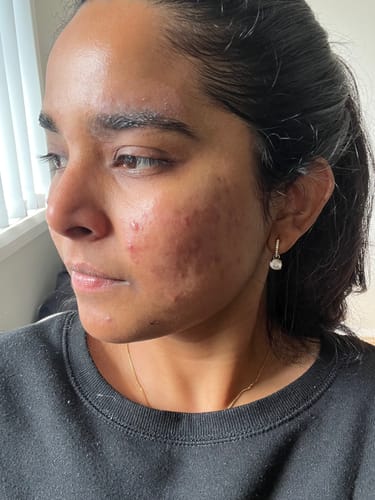 Customer photo review of Advanced Acne Program™