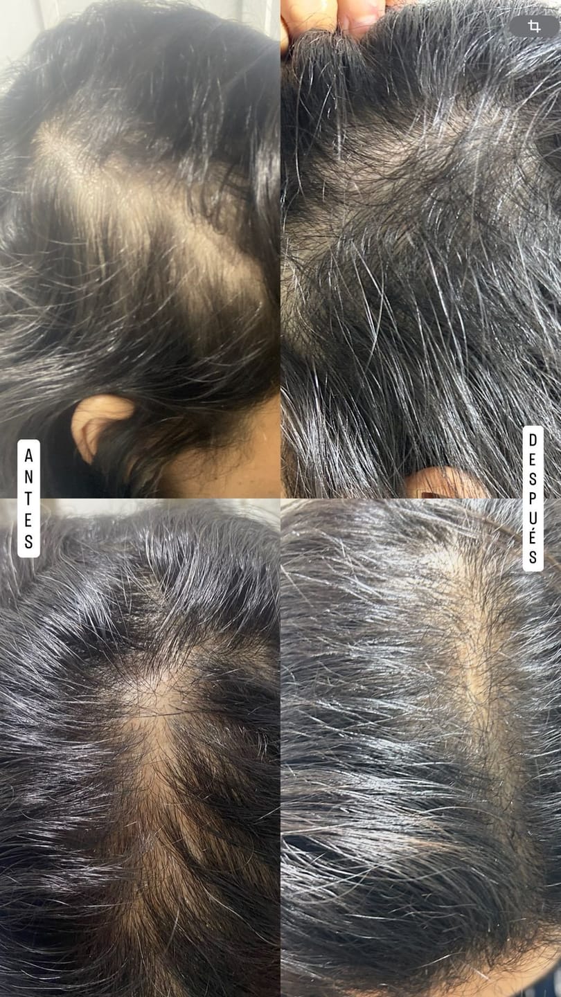 Customer photo review of DUO ANTIcaída CRECIMIENTO INTENSIVO Bomba + Tónico