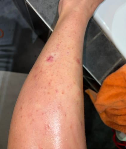 Customer photo review of Bumps Be Gone