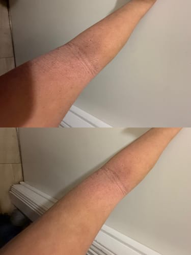 Customer photo review of Eczema Scratch Mitten