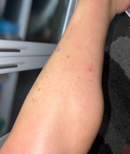 Customer photo review of Bumps Be Gone