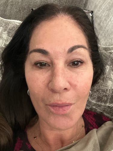 Customer photo review of The Micro Infusion System™ 2 Month | 4 Treatments