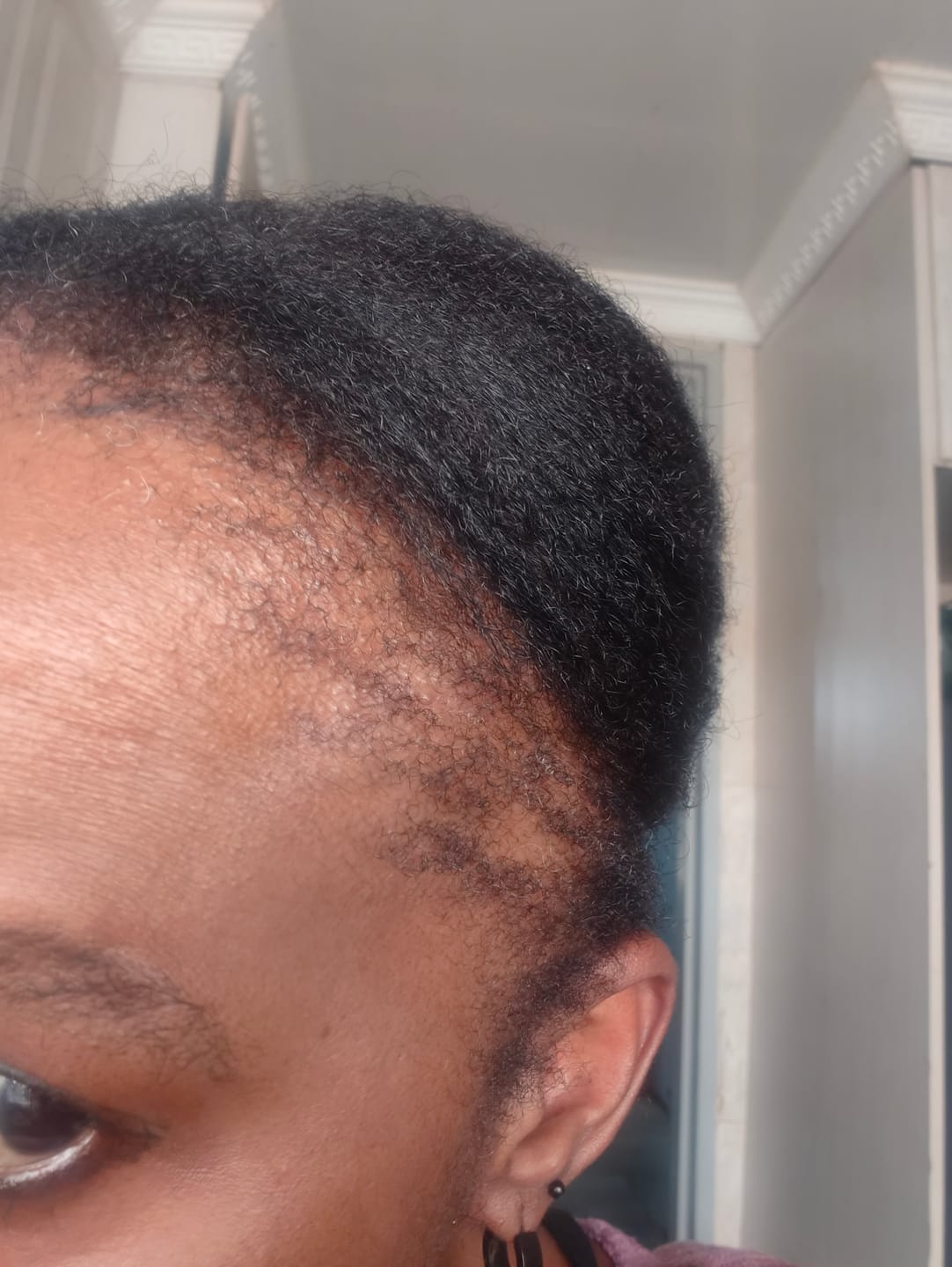 Customer photo review of Hairline Fortifying Serum 30ml - Minoxidil