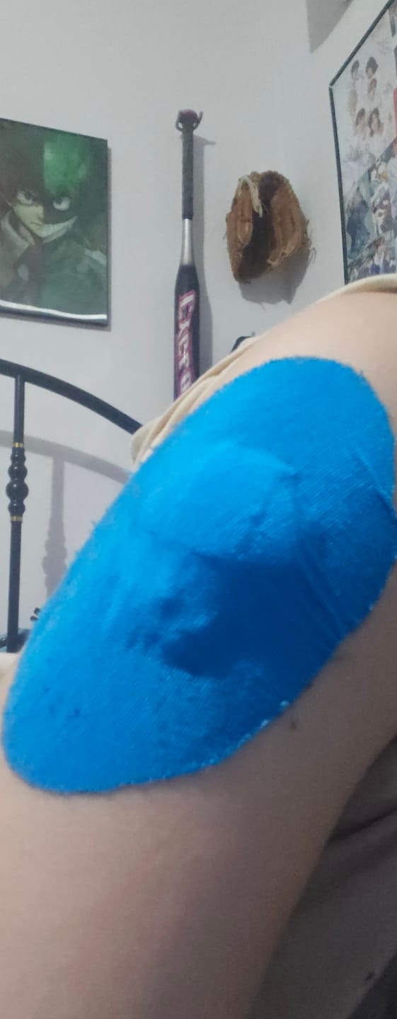 Customer photo review of Skin Grip Original - Medtronic Guardian/Enlite Adhesive Patches