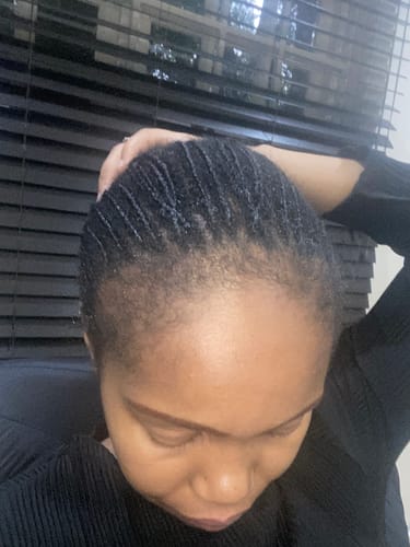 Customer photo review of Minoxidil REGULAR (2%) strength SOLUTION, 1 x 60ml pack