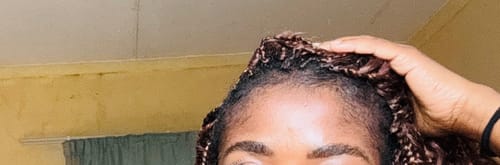 Customer photo review of Minoxidil REGULAR (2%) strength SOLUTION, 3x60ml pack