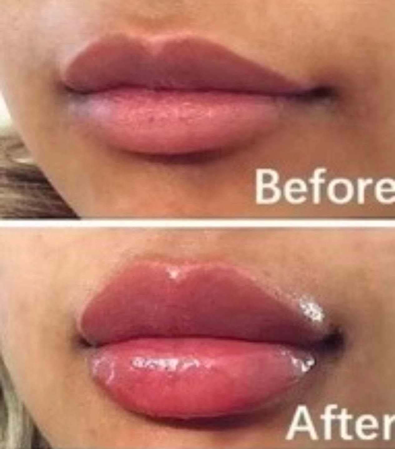 Customer photo review of Plumping Lip filler