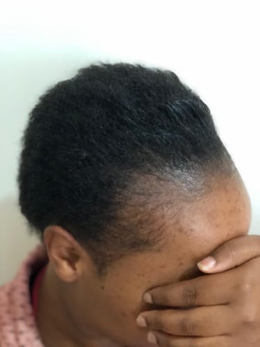 Customer photo review of Minoxidil High Strength (5%) SOLUTION, 3x60ml pack