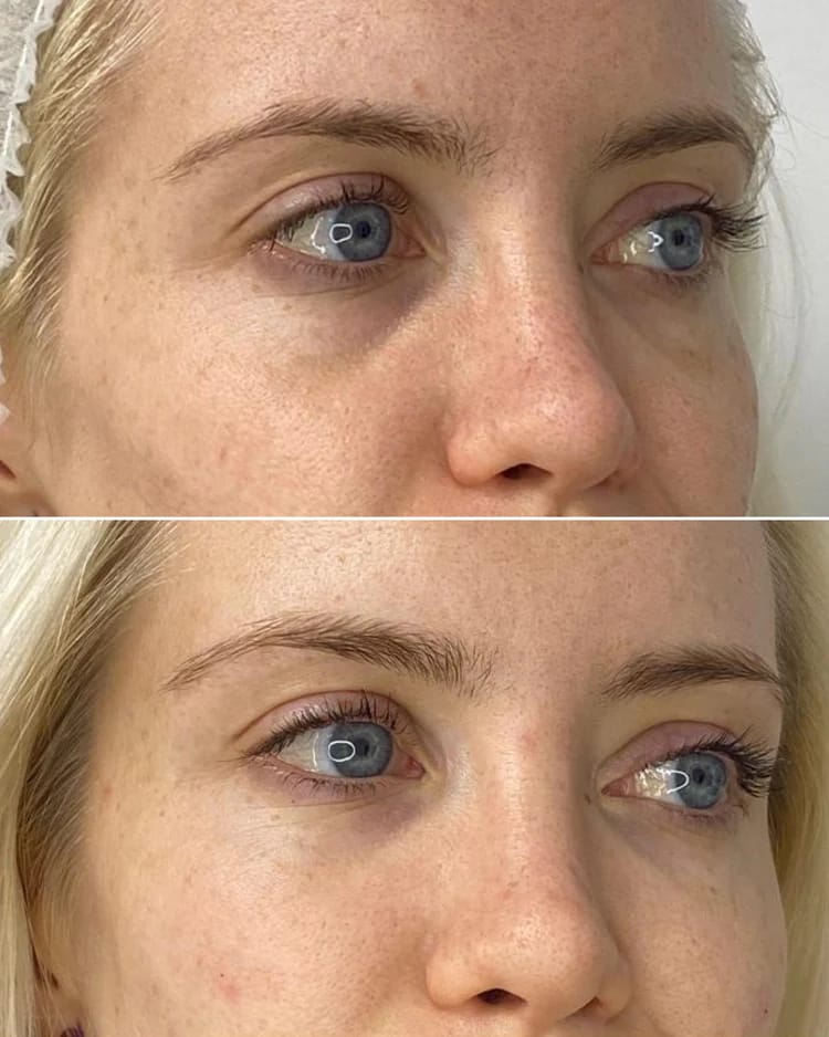 Customer photo review of Anti-ojeras y Bolsas Dr. Retinol