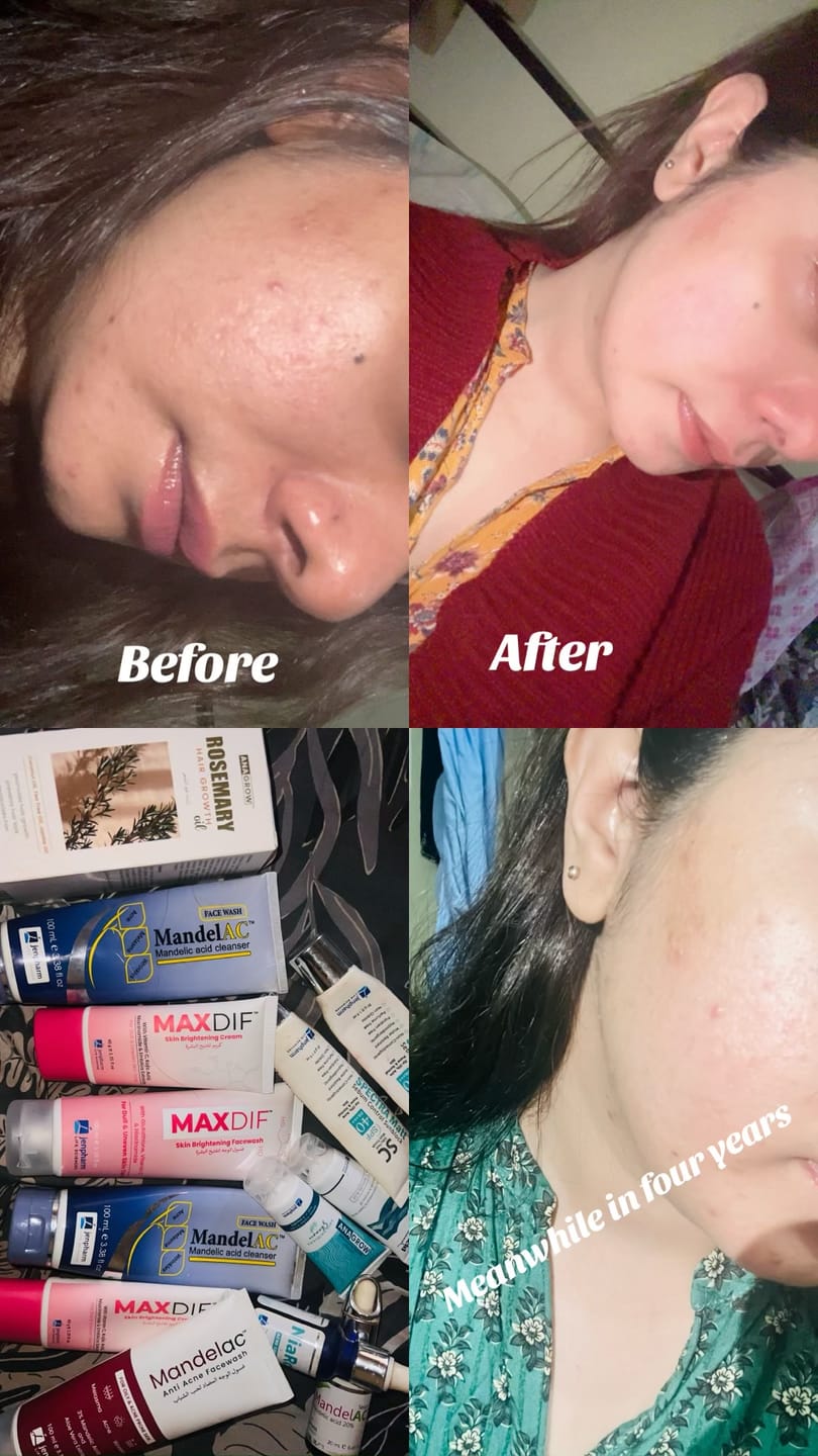 Customer photo review of MandelAC Serum