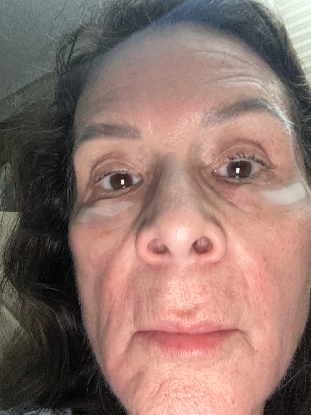 Customer photo review of Micro Infusion Patches