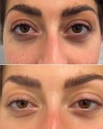 Customer photo review of Anti-ojeras y Bolsas Dr. Retinol