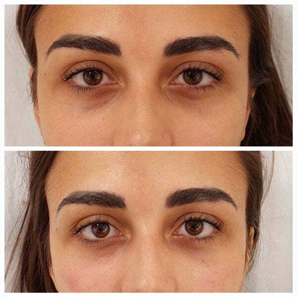 Customer photo review of Anti-ojeras y Bolsas Dr. Retinol