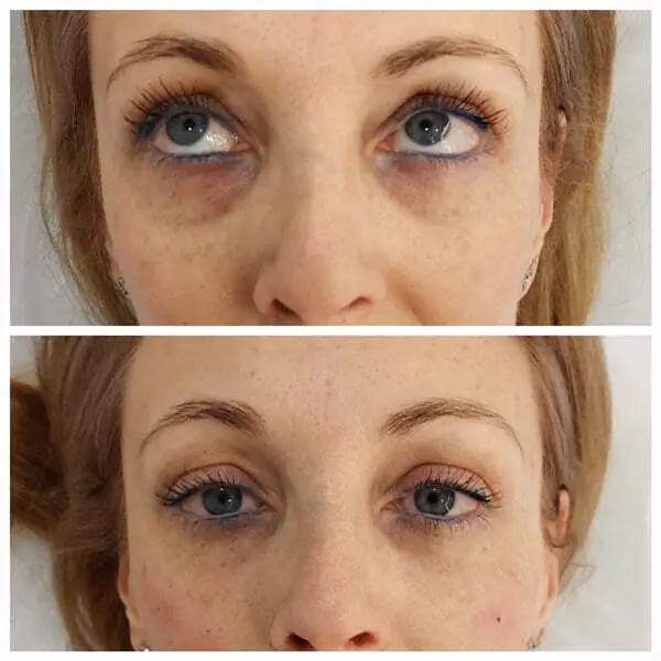 Customer photo review of Anti-ojeras y Bolsas Dr. Retinol