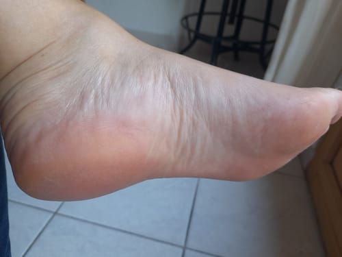 Customer photo review of LOVASKIN INSTANT FOOT PEEL Essential Kit - Great value, 25 uses in one bottle