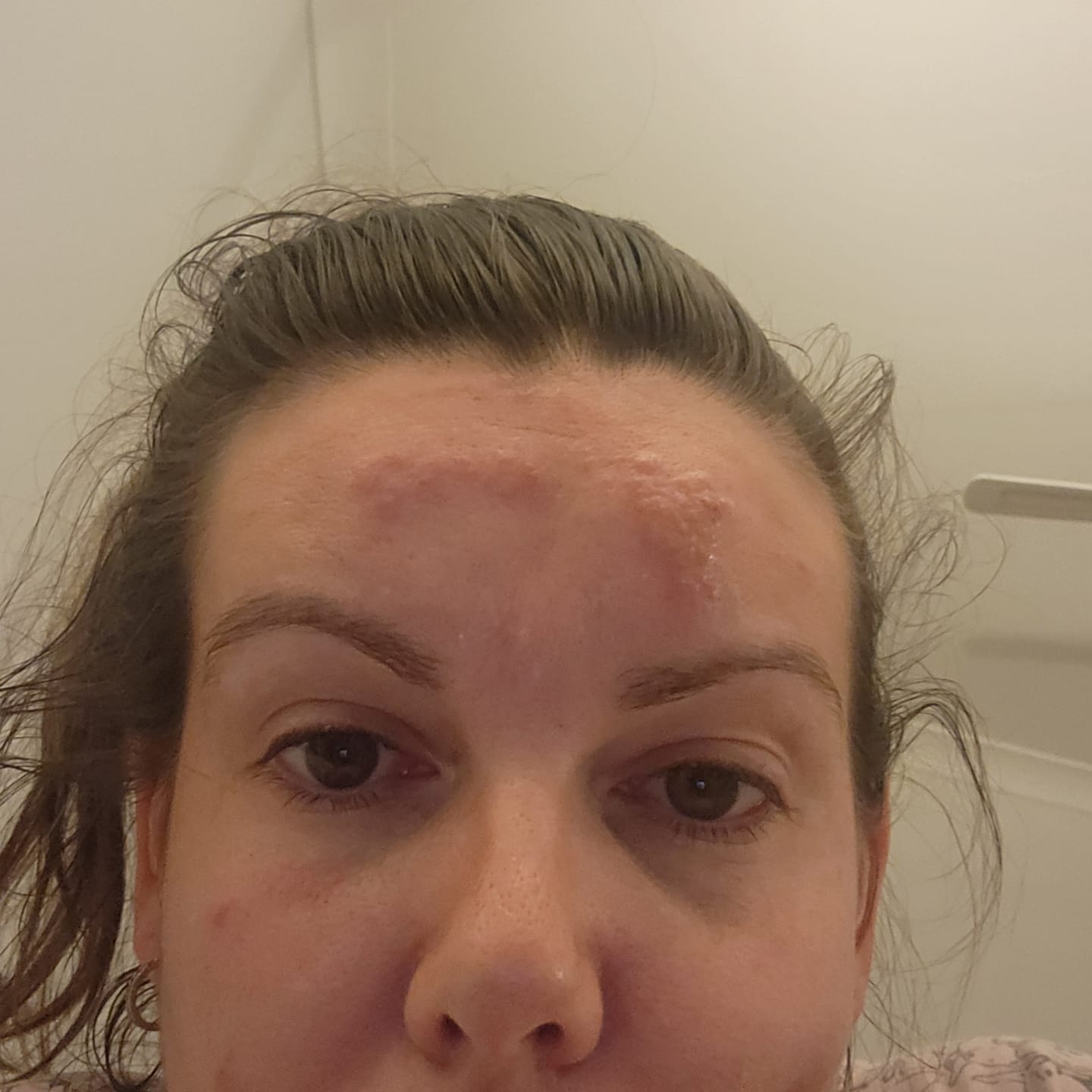Customer photo review of Kayute Hydroquinone 5.1% White Cream 20g