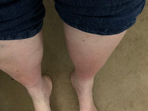 Customer photo review of MEDIAS DE COMPRESIÓN LUMILEGS - Piernas livianas todo el día