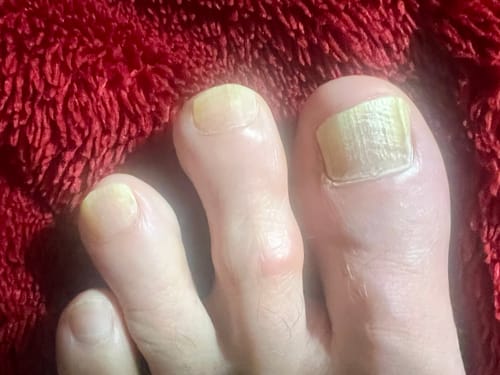 Customer photo review of Nuvex Fungal Nail Renewal Patches