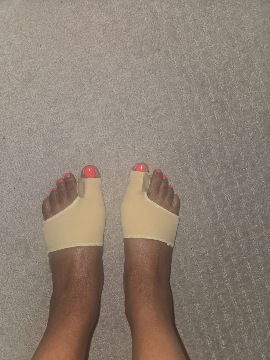 Customer photo review of Treatmedy™ Orthopedic Daytime Bunion Sleeve