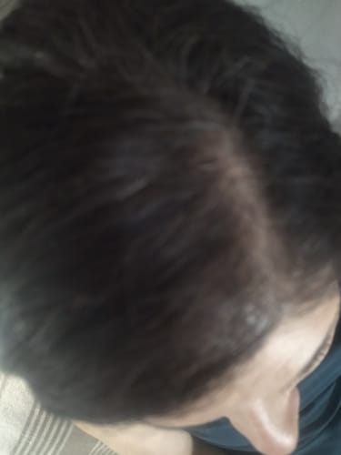 Customer photo review of Minoxidil High Strength (5%) SOLUTION, 3x60ml pack