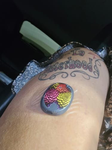 Customer photo review of Eversense CGM Stickers