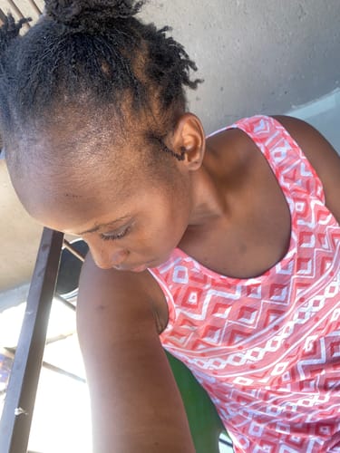 Customer photo review of Minoxidil High Strength (5%) SOLUTION, 3x60ml pack