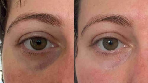 Customer photo review of Natural Botulin LED-Infrarot-Maske