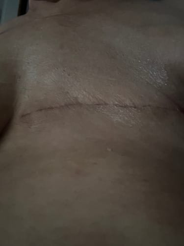 Customer photo review of Calendula Spray & Cream for Radiation Therapy Patients