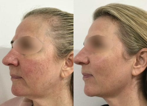 Customer photo review of Natural Botulin LED-Infrarot-Maske