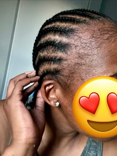 Customer photo review of Minoxidil DOUBLE ACTION FOAM, MEN ONLY 3x60ml Pack