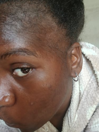 Customer photo review of Minoxidil High Strength (5%) SOLUTION, 3x60ml pack