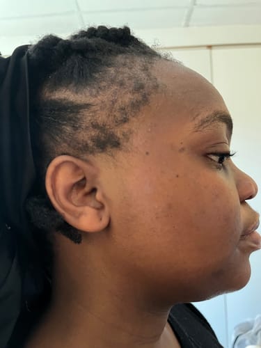 Customer photo review of Minoxidil High Strength (5%) SOLUTION, 3x60ml pack