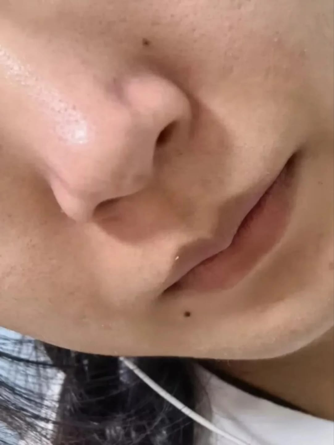 Customer photo review of Microdermabrasion Pore Extractor For Clearer Skin And Light Therapy