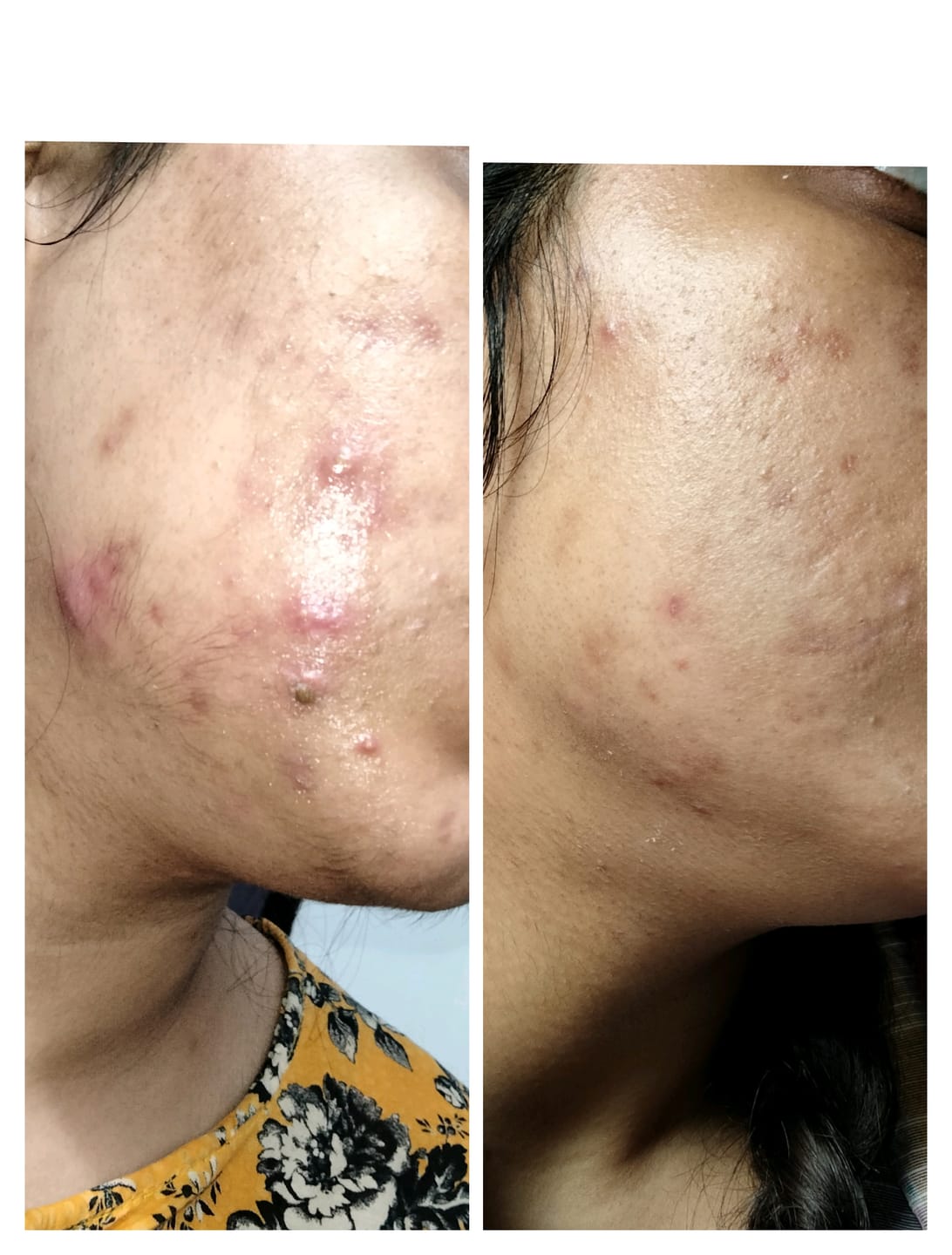 Customer photo review of MandelAC Serum