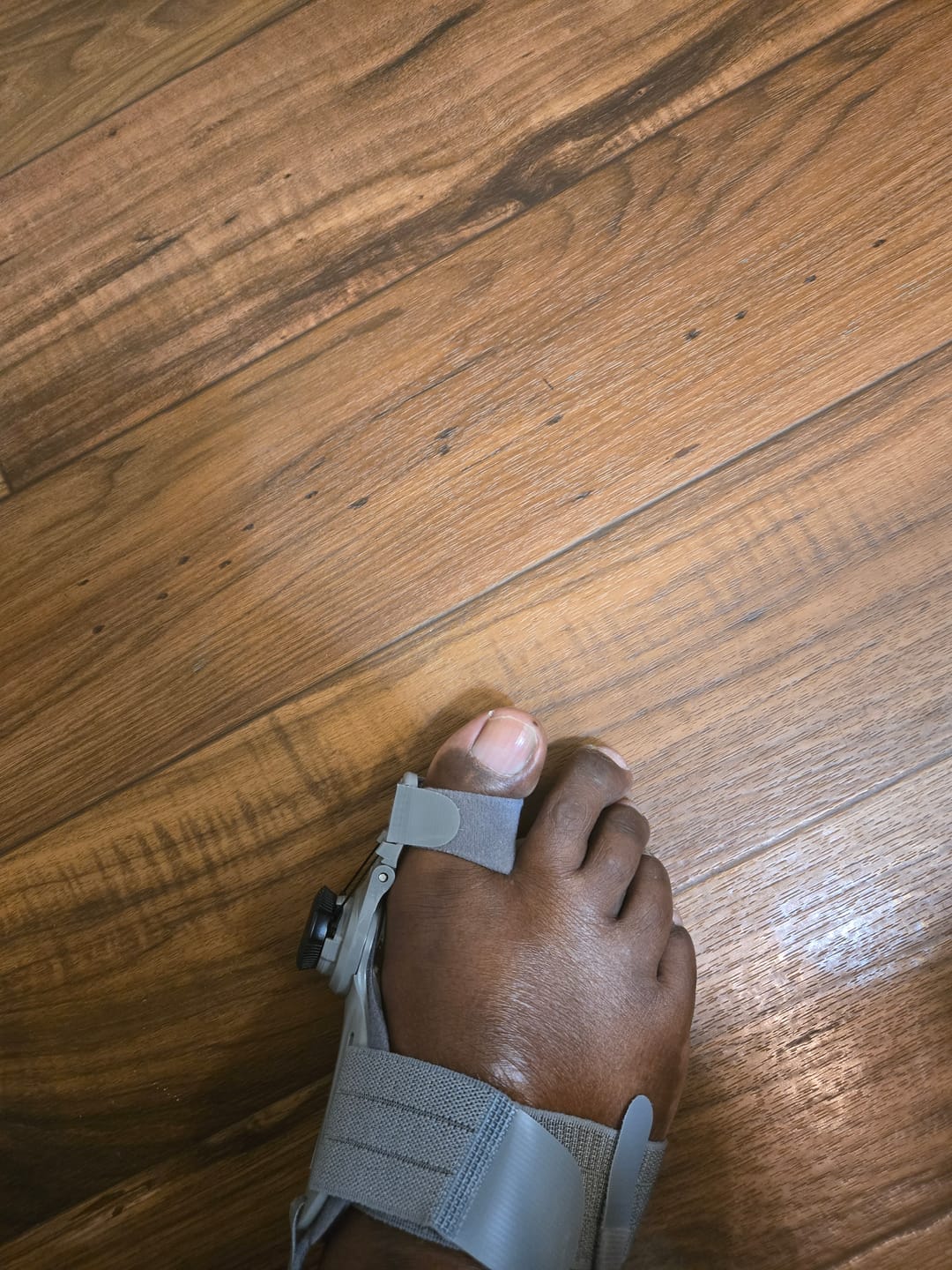 Customer photo review of Treatmedy™ Bunion Fix