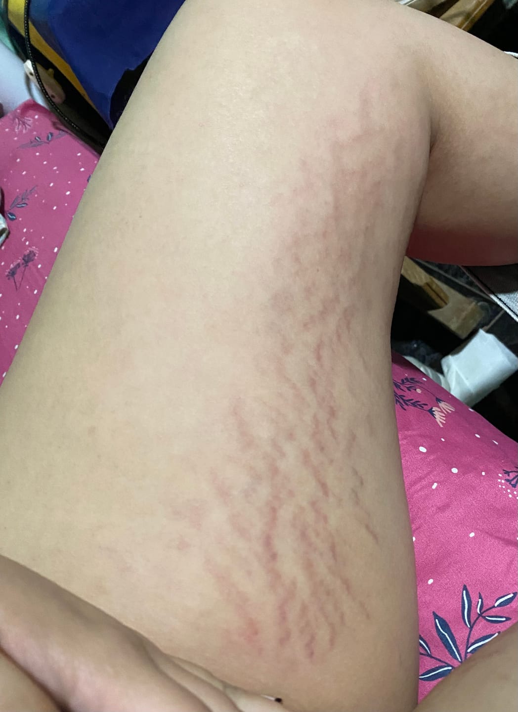 Customer photo review of Crema para Estrías  Emily • 200ml