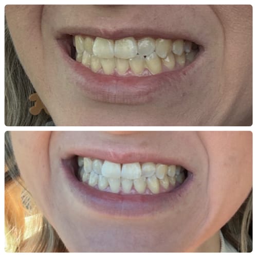 Customer photo review of Bianca Bright Advanced Whitening Pen