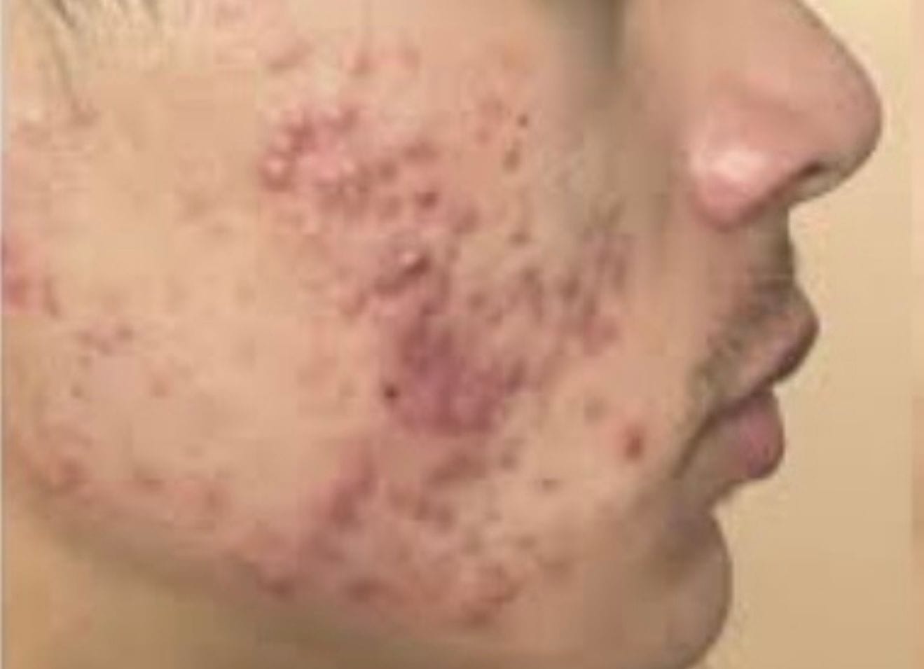 Customer photo review of Acne Formula
