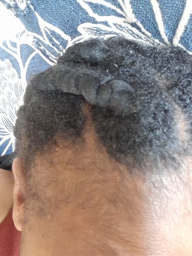 Customer photo review of Minoxidil High Strength (5%) SOLUTION, 3x60ml pack