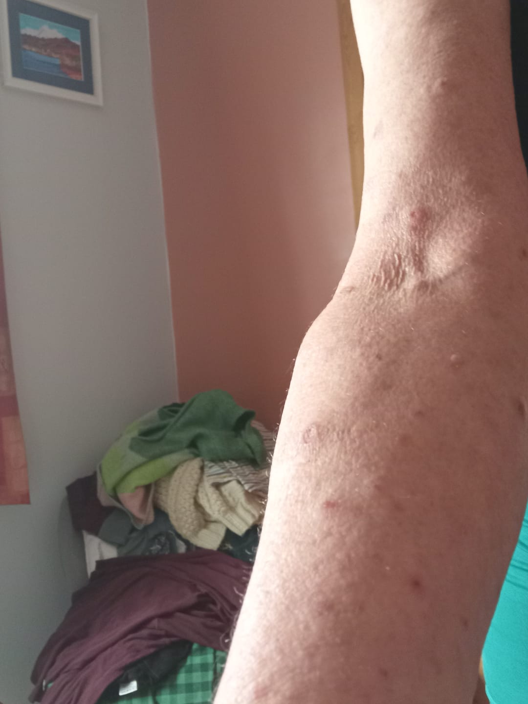 Customer photo review of Bioskin DermaSpray Intensive
