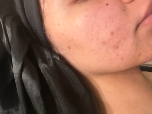 Customer photo review of FRESH FACE PACKAGE (Cleanser x Toner x Serum)
