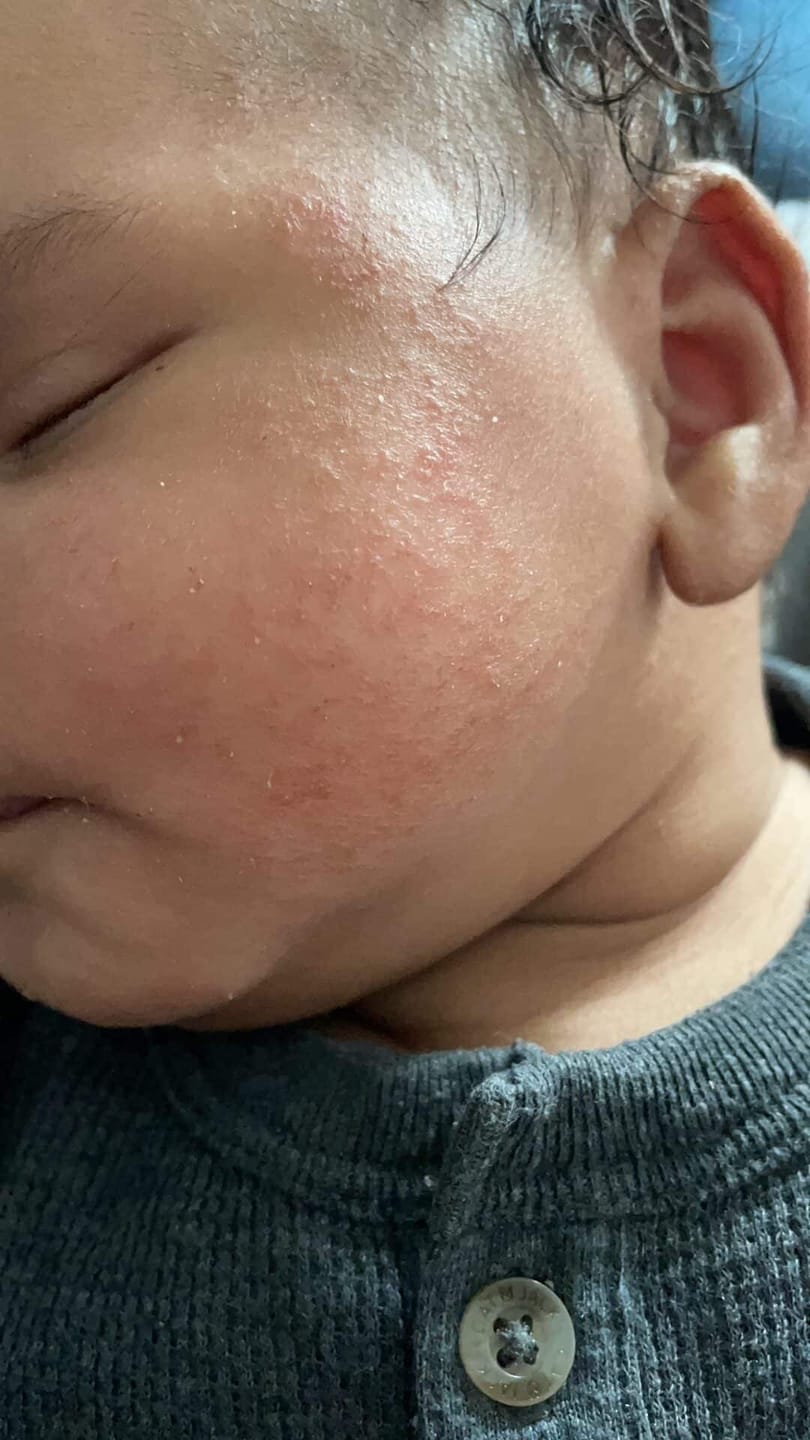 Customer photo review of Baby Bum Balm