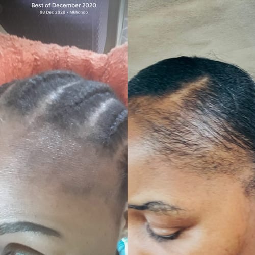 Customer photo review of Minoxidil High Strength (5%) SOLUTION, 3x60ml pack