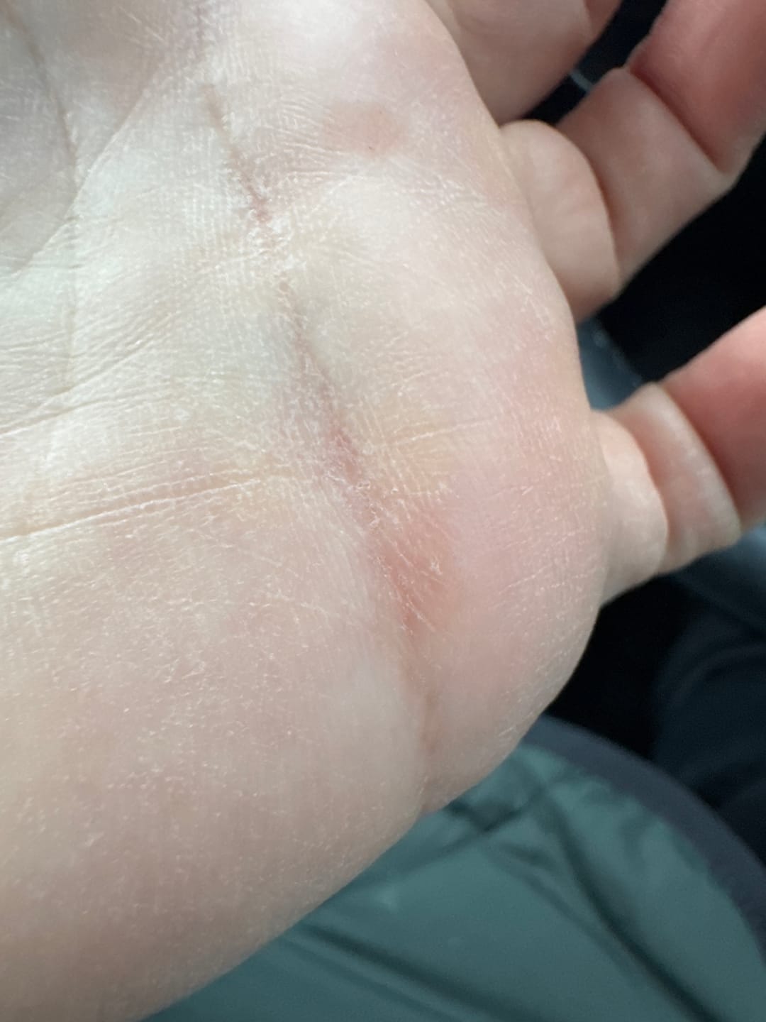 Customer photo review of The Wartabater | Precision Wart  Tool